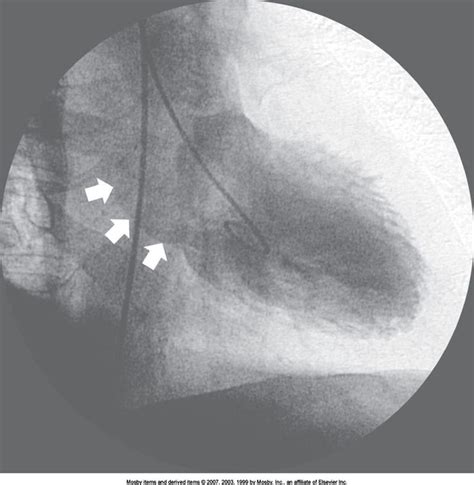 lv gram ncbi